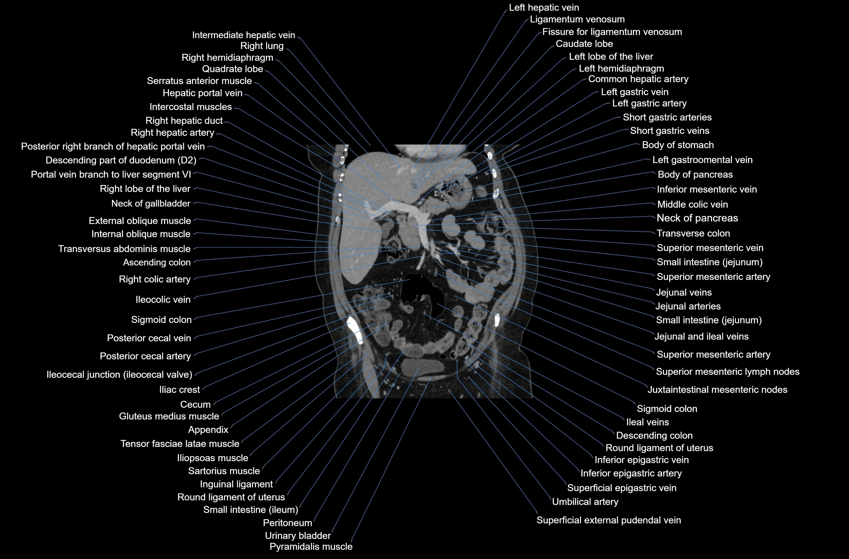 CT abdomen coronal cross sectional anatomy labelled radiology image-00034.webp